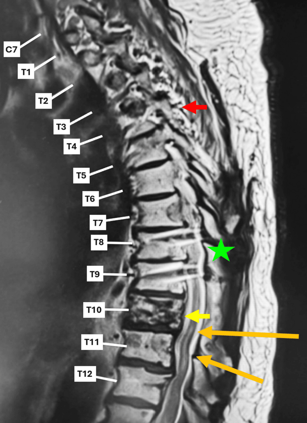 Spinal Cord Infarction Following Zoledronic Acid Administration in a Patient With Metastatic Prostate Cancer