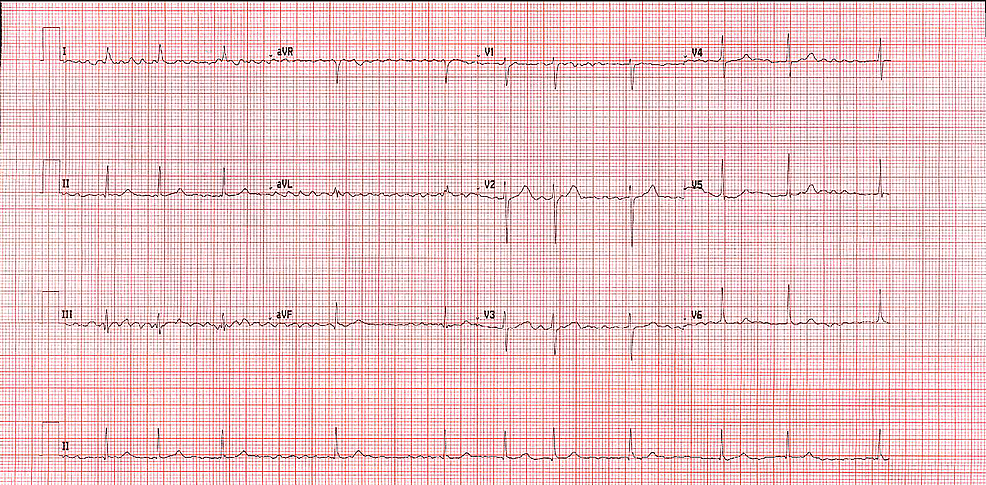 New-Onset Atrial Fibrillation and Multiple Systemic Emboli in a COVID ...