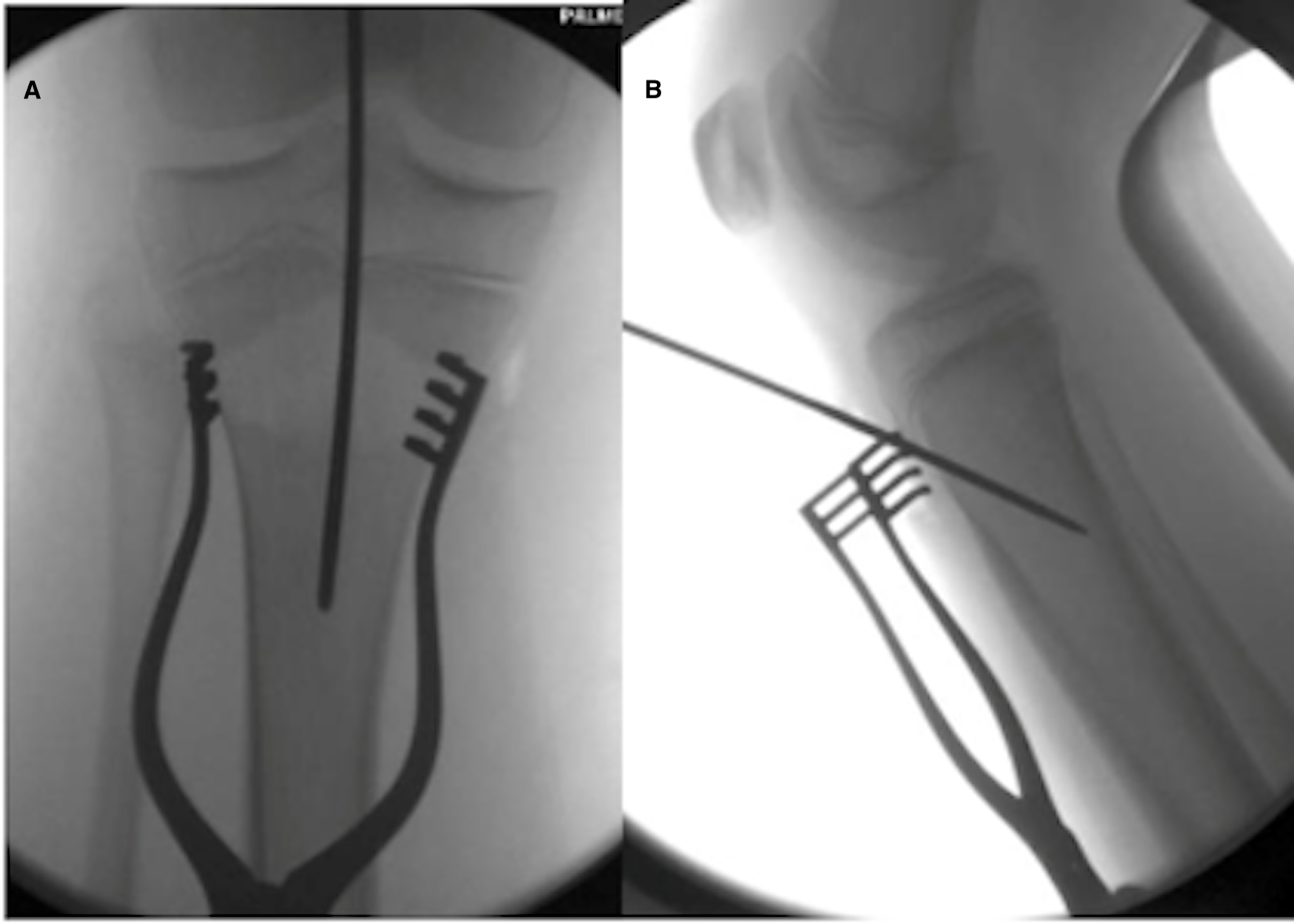 Cureus | Physeal-Sparing Rigid Intramedullary Nailing in Adolescent Tibial  Shaft Fractures: A Pilot Study | Article