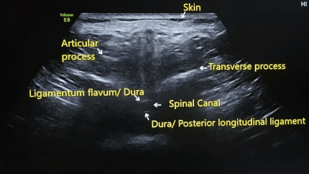 Correlation Between the Body Mass Index and the Distance From the Skin to the Lumbar Epidural Space in Term Parturients