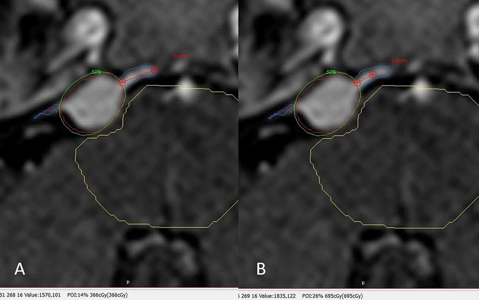 Cureus | Multiplatform Radiosurgery for Intracranial Meningiomas and Dose  to the Dural Tail