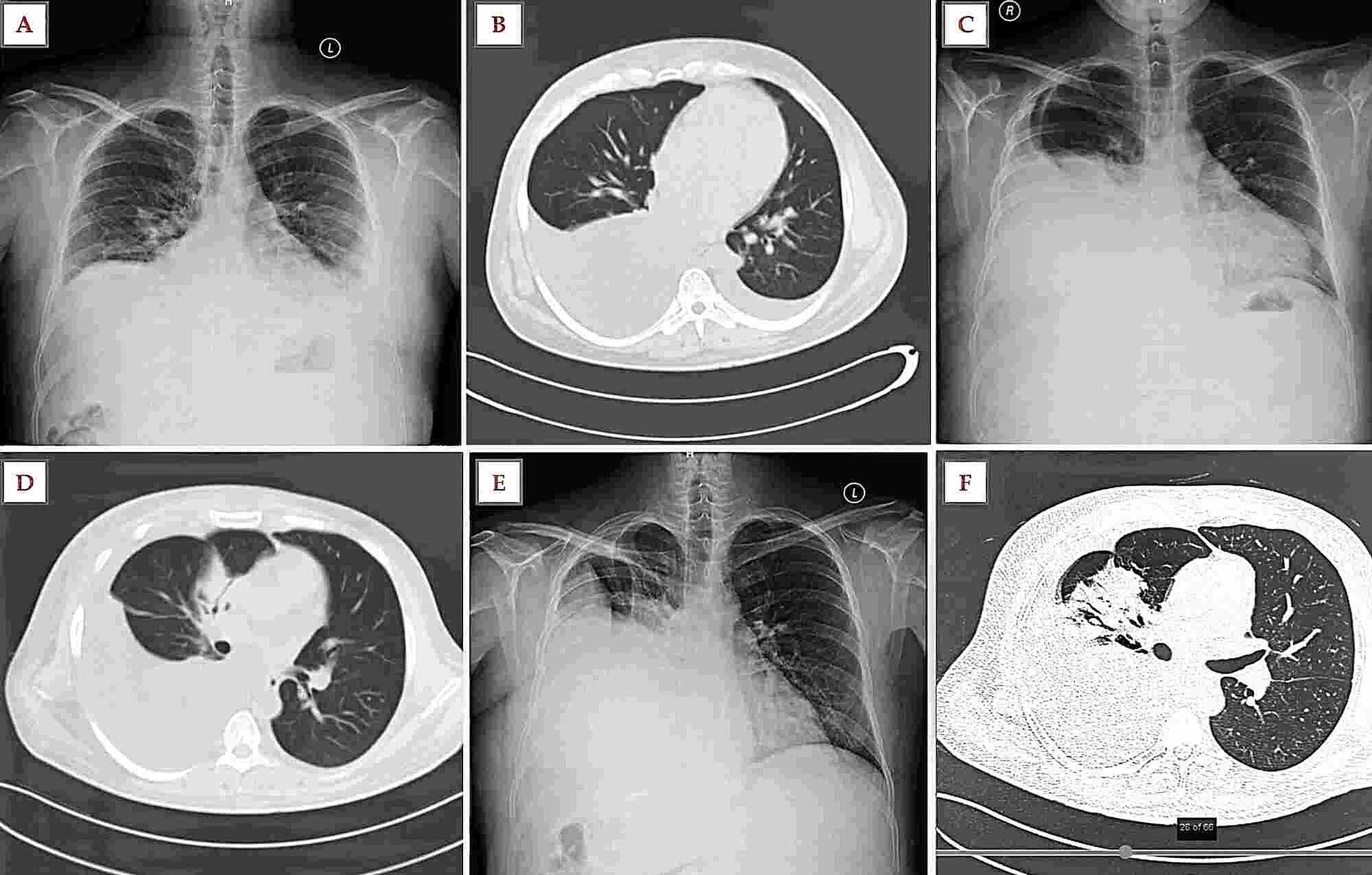 pleural fluid pleural fluid