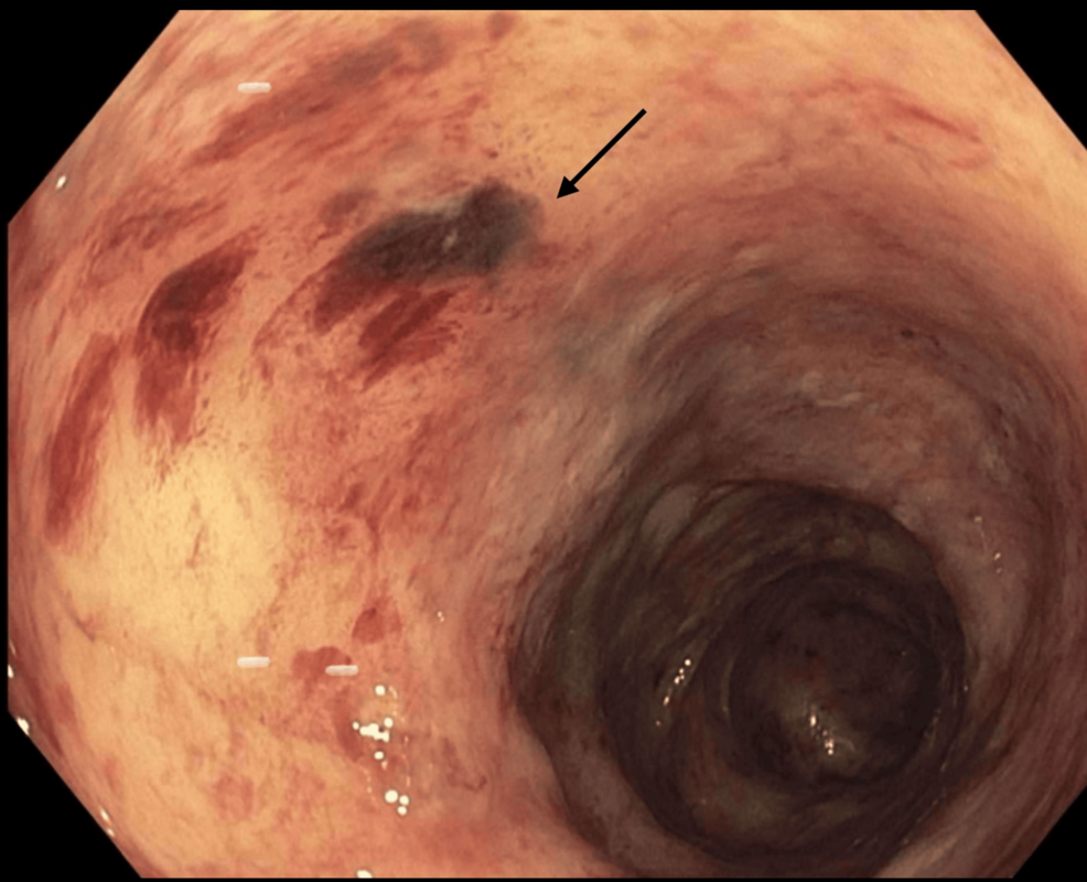 can tirzepatide cause ulcers Ischemic Colitis Associated With Tirzepatide Therapy in a Young Female  Patient: A Case Report