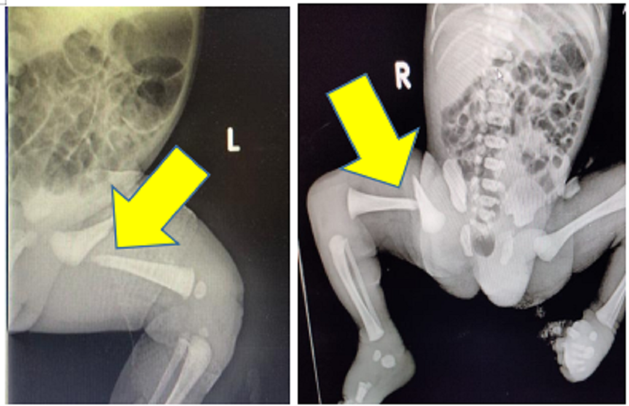 Cureus | Femur Shaft Fracture in Newborns: A Report of Two Cases | Article