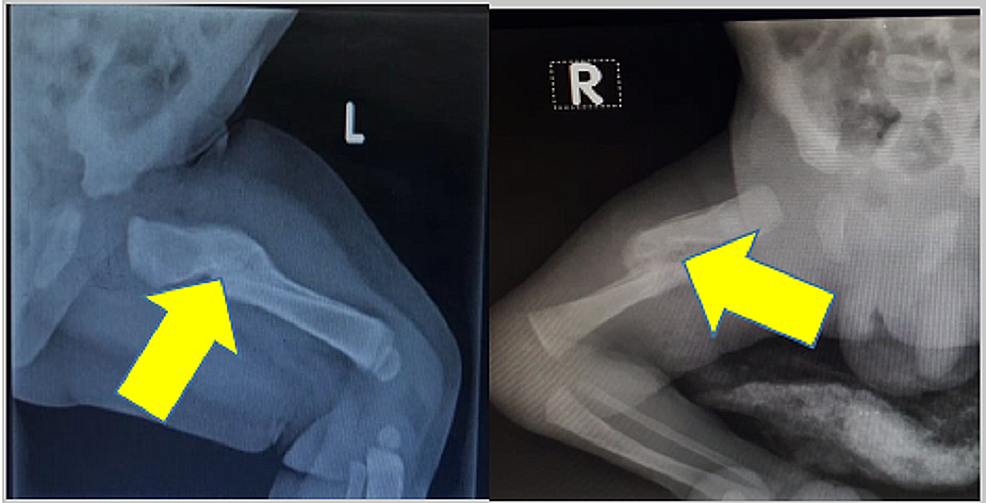 Cureus | Femur Shaft Fracture in Newborns: A Report of Two Cases