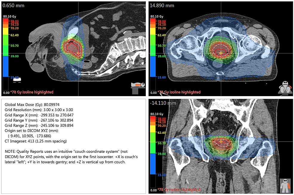 Dose-Distribution-for-VMAT-Plan