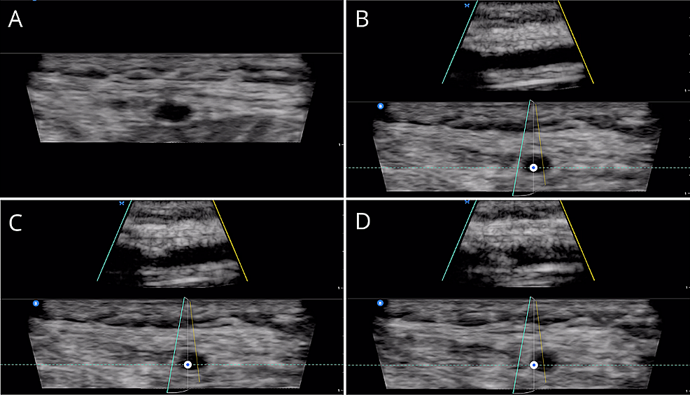 Views-of-the-radial-artery-during-sequential-stages-of-arterial-line-access-and-insertion-with-the-Butterfly-IQ+-handheld-ultrasound-device