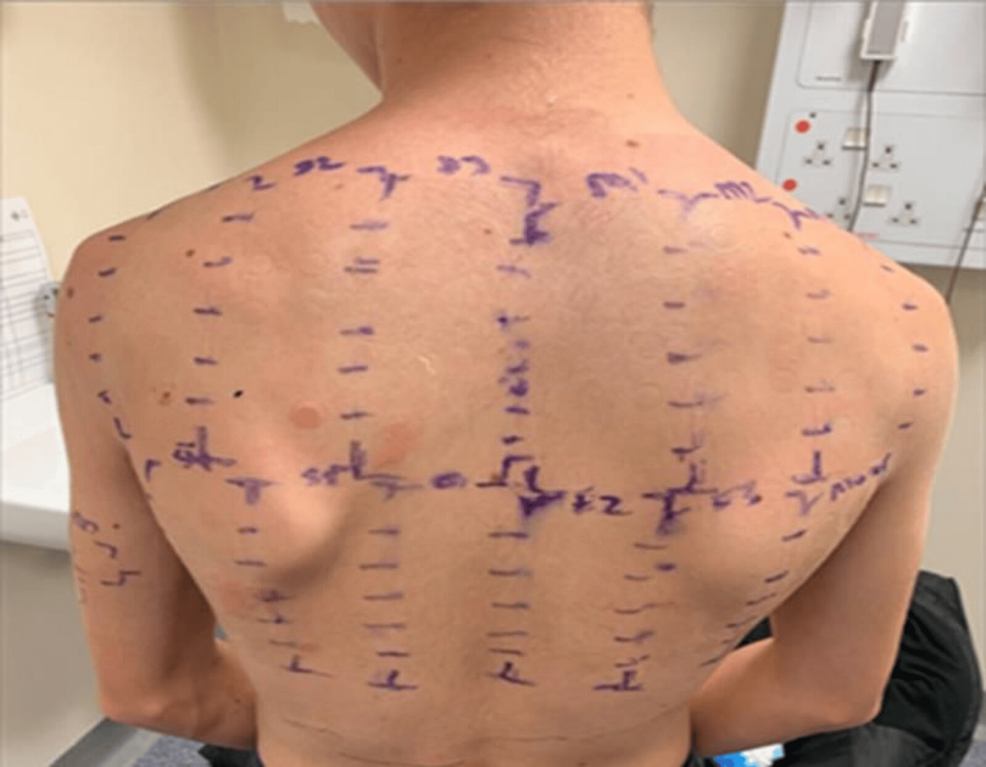 Photo-of-the-back-showing-positive-patch-test-results-of-day-four