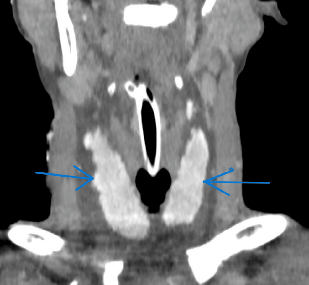 Shock-Related Thyroid Changes: A Rare Presentation in a Young Patient With Hemorrhagic Shock Secondary to a Road Traffic Accident
