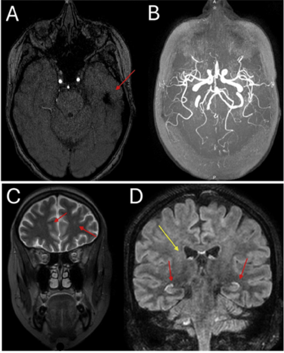 Diagnostic Challenges in a Patient With Systemic Lupus