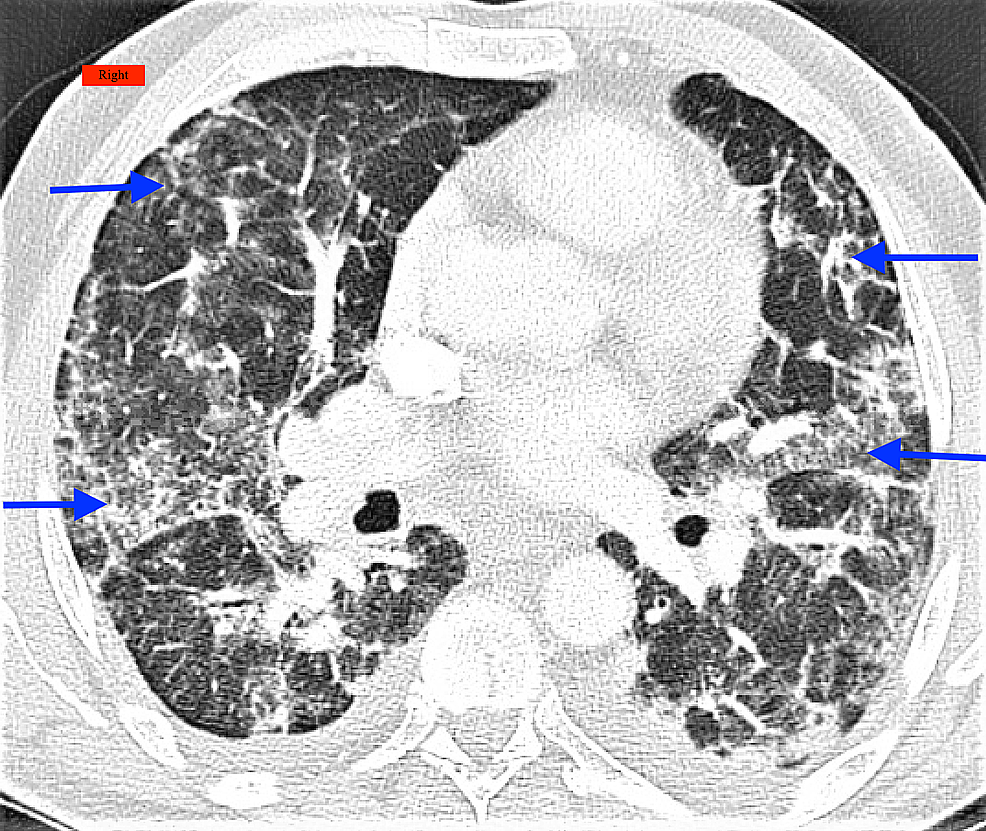 cureus-restrictive-lung-disease-in-patients-with-subclinical-free