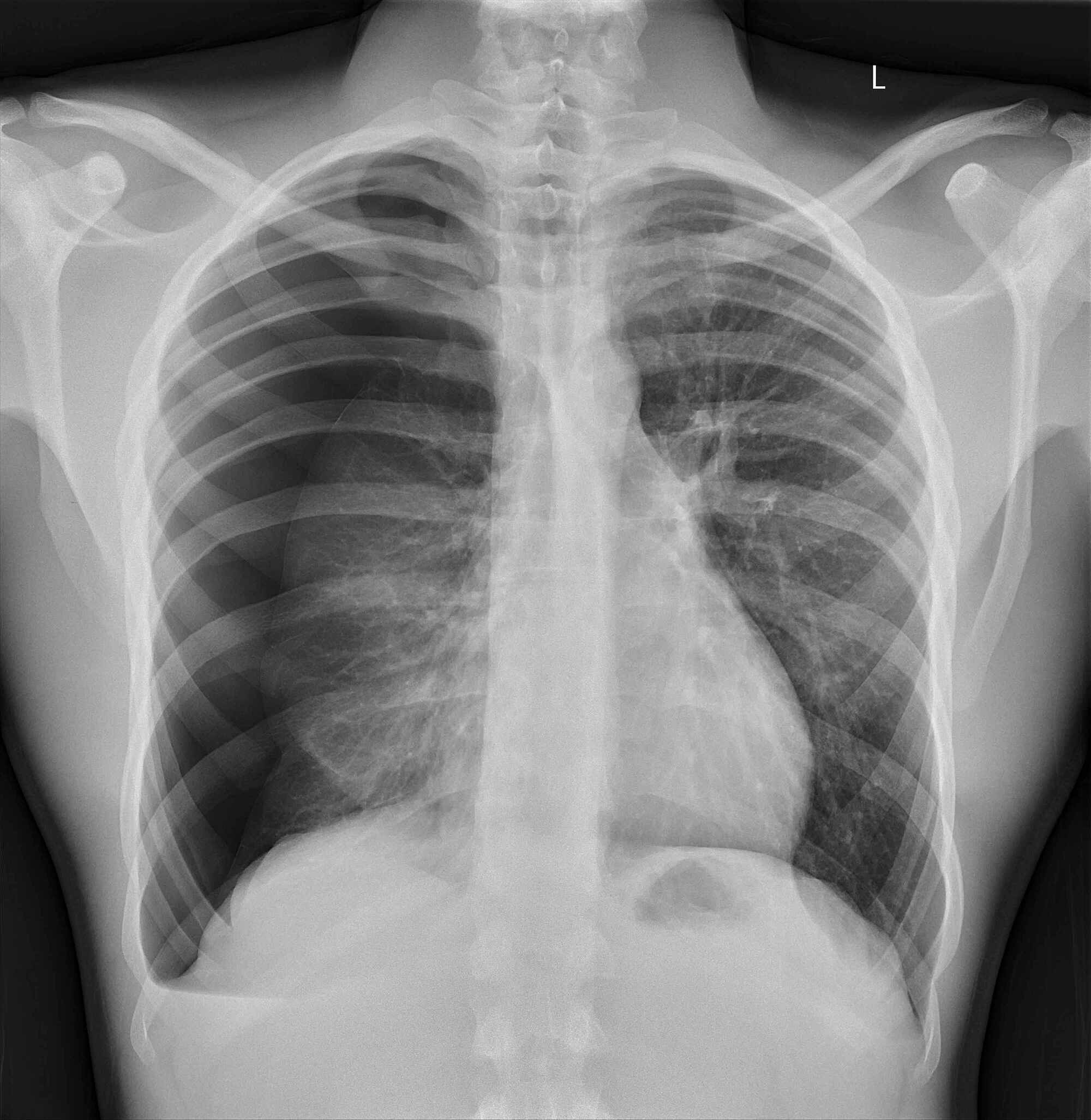 Pneumothorax X Ray Stock Image F0341404 Science Photo - vrogue.co