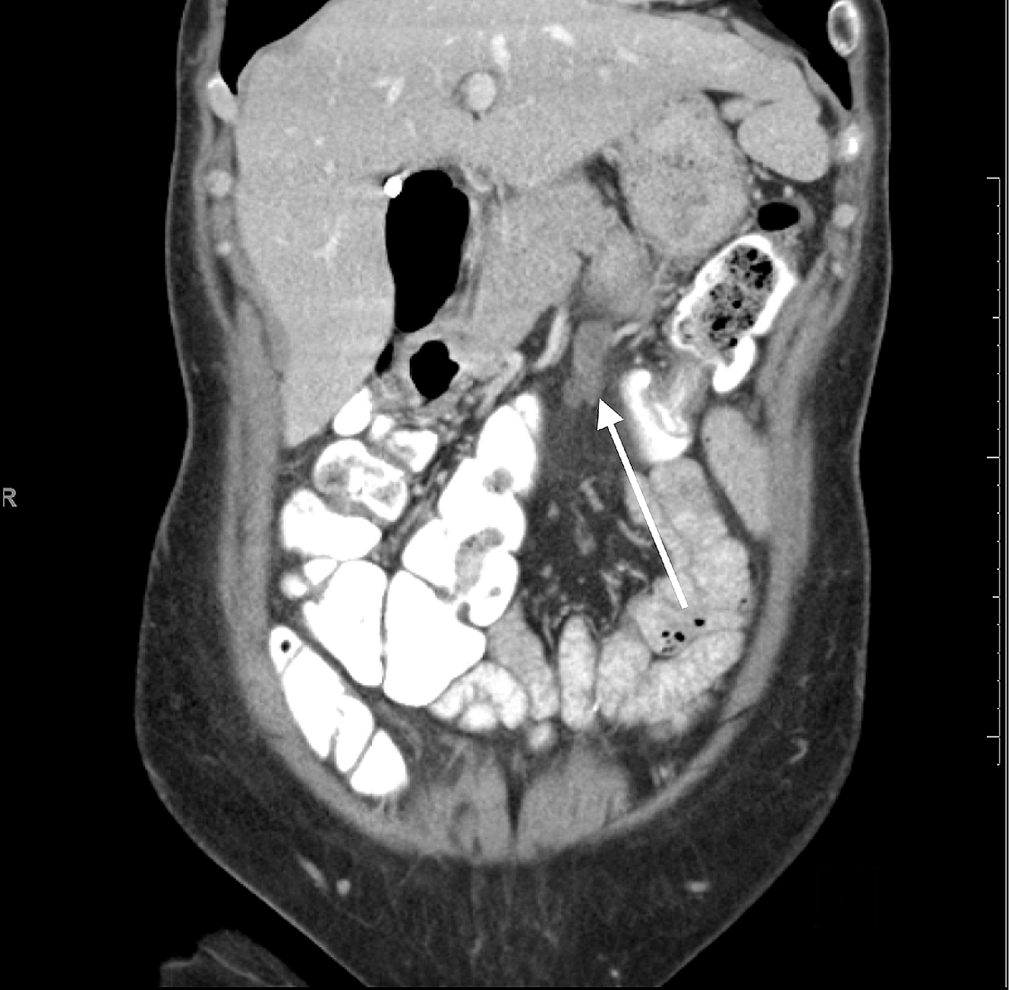 Cureus Surgical Excision of Sclerosing Mesenteritis, Exploration of