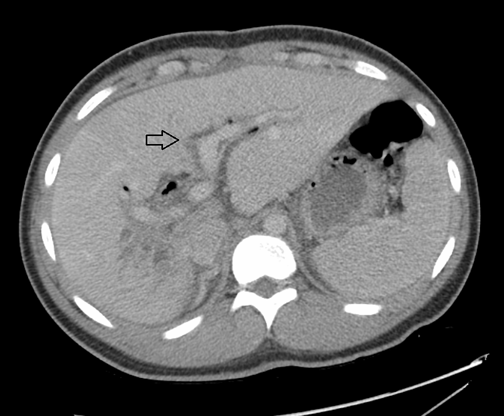 Cureus | A Rare Case of Ascariasis-Induced Cholangitis Complicated With ...