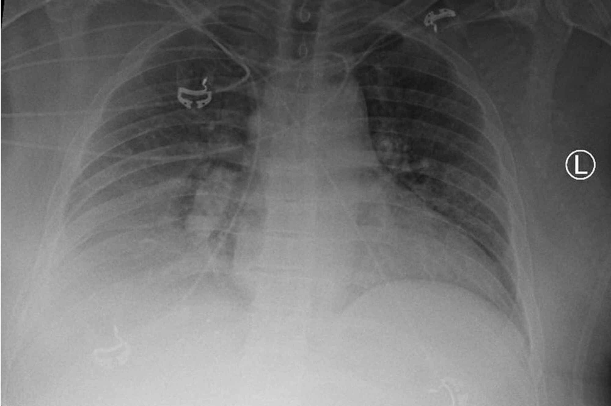 Cureus Acute Tension Hydrothorax in a Cirrhotic Patient Cureus Acute Tension Hydrothorax in a Cirrhotic Patient