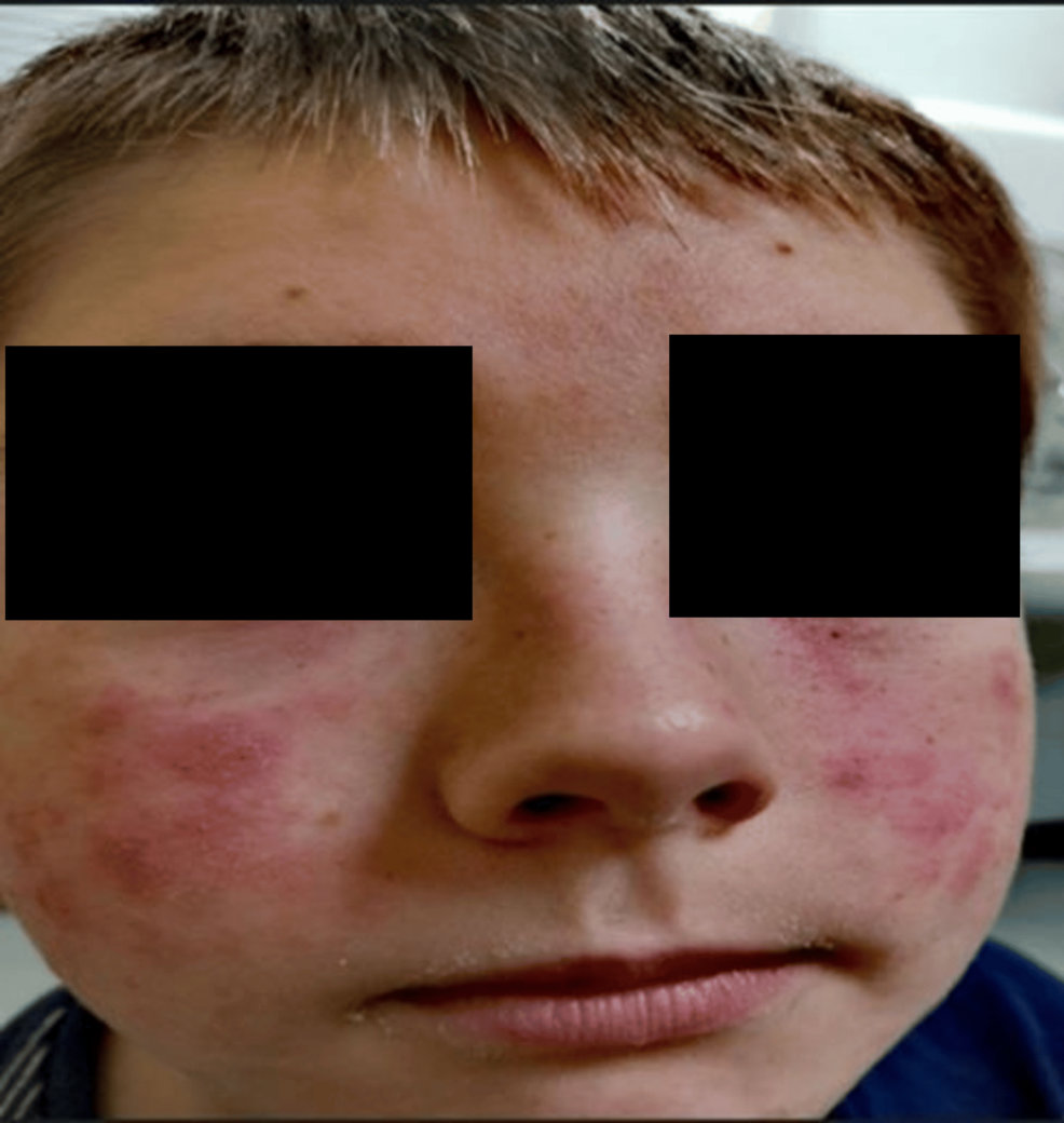 -Eczematous-rash-localized-to-the-cheeks-and-periorbital-areas-corresponding-to-VR-headset-contact-sites