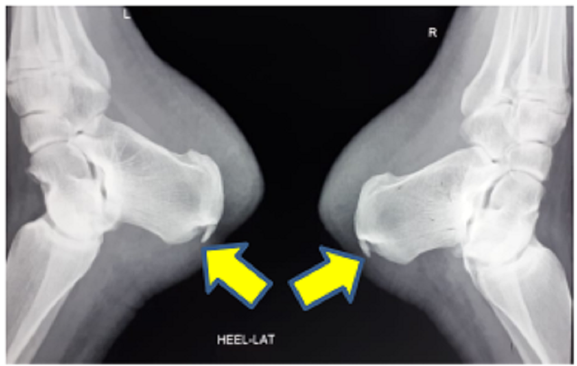 Cureus Mulholland Deformity With Pump Bump
