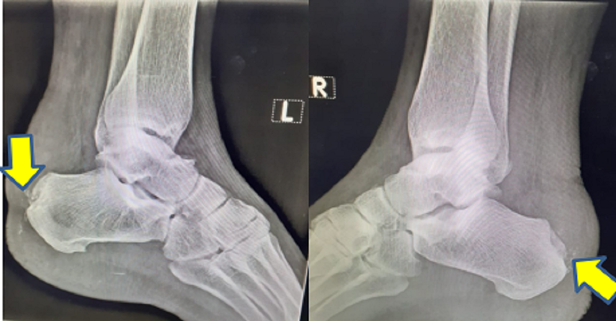 Cureus Mulholland Deformity With Pump Bump