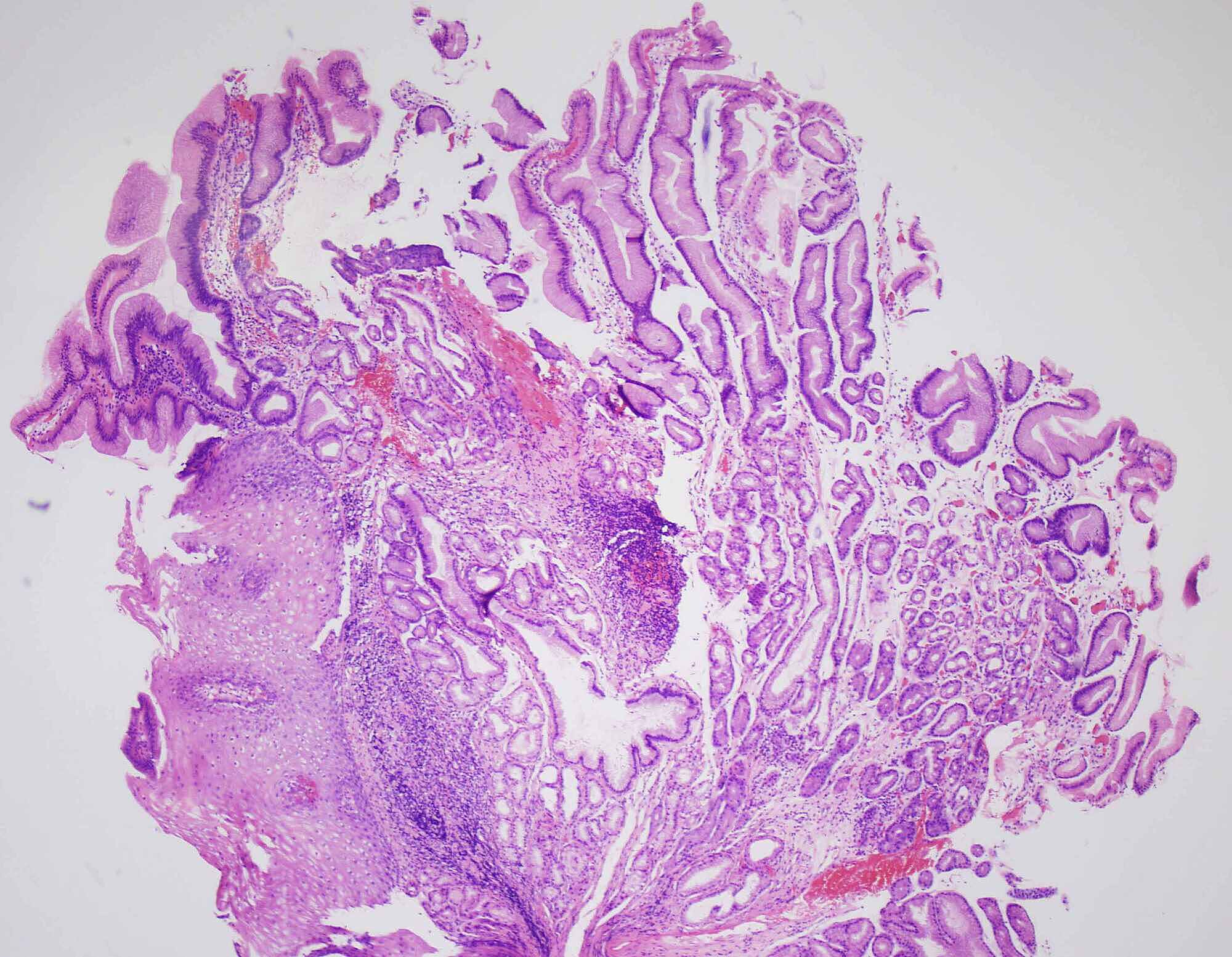 Cureus An Unusual Case of Esophageal Hyperplastic Polyp with