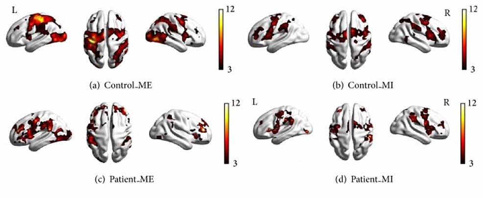 Brain-activation-in-the-control-and-patient-groups-under-different-conditions.-(a)-Control-subjects-during-motor-execution;-(b)-controls-during-motor-imagery;-(c)-patients-during-motor-execution;-(d)-patients-during-motor-imagery.