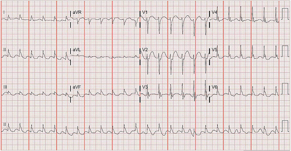 Cureus | Electrocardiograms Revealing Epsilon Waves Following Use of ...