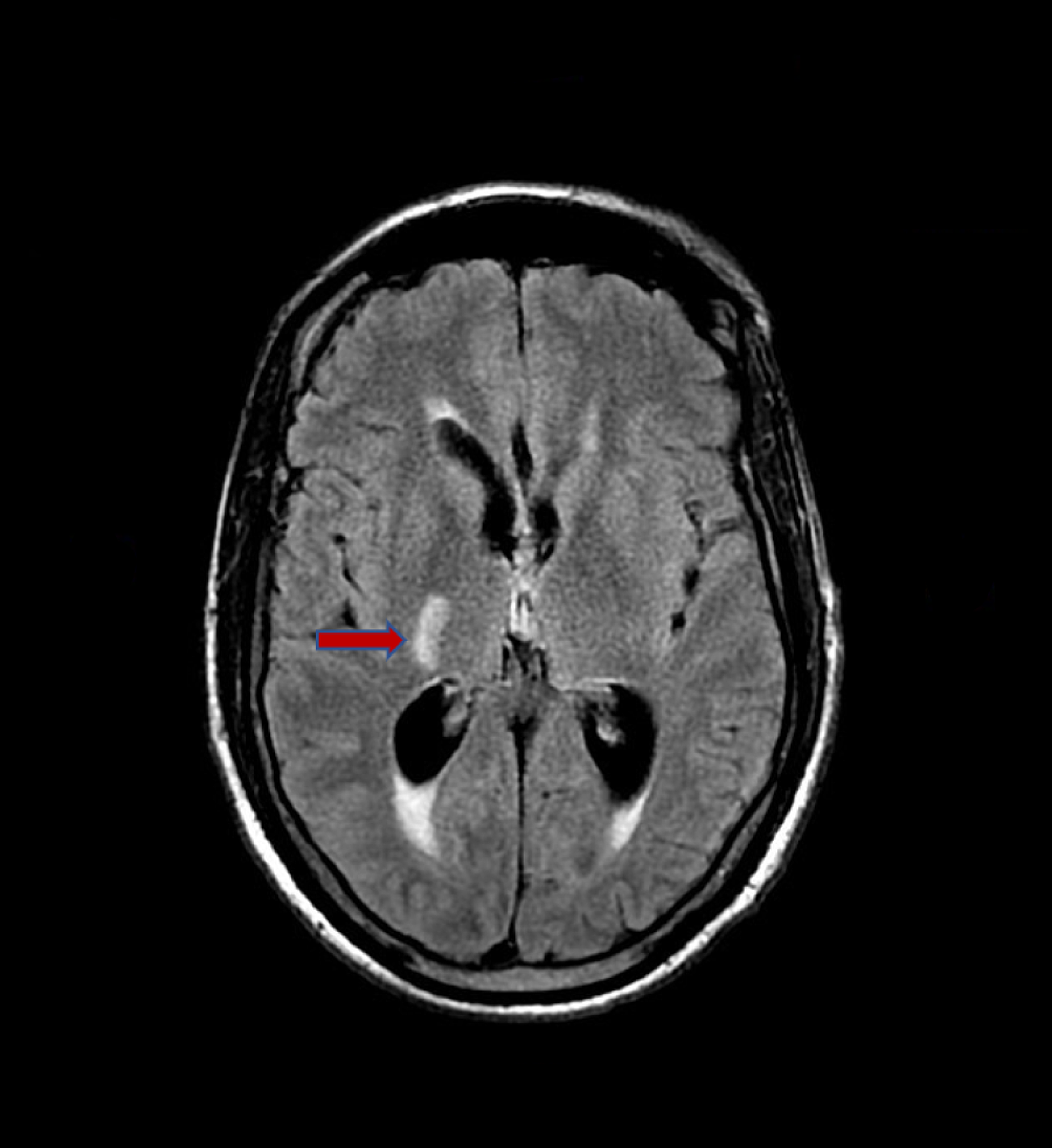 Cureus Disseminated Cryptococcal Disease In A Patient With Monoclonal Hot Sex Picture 