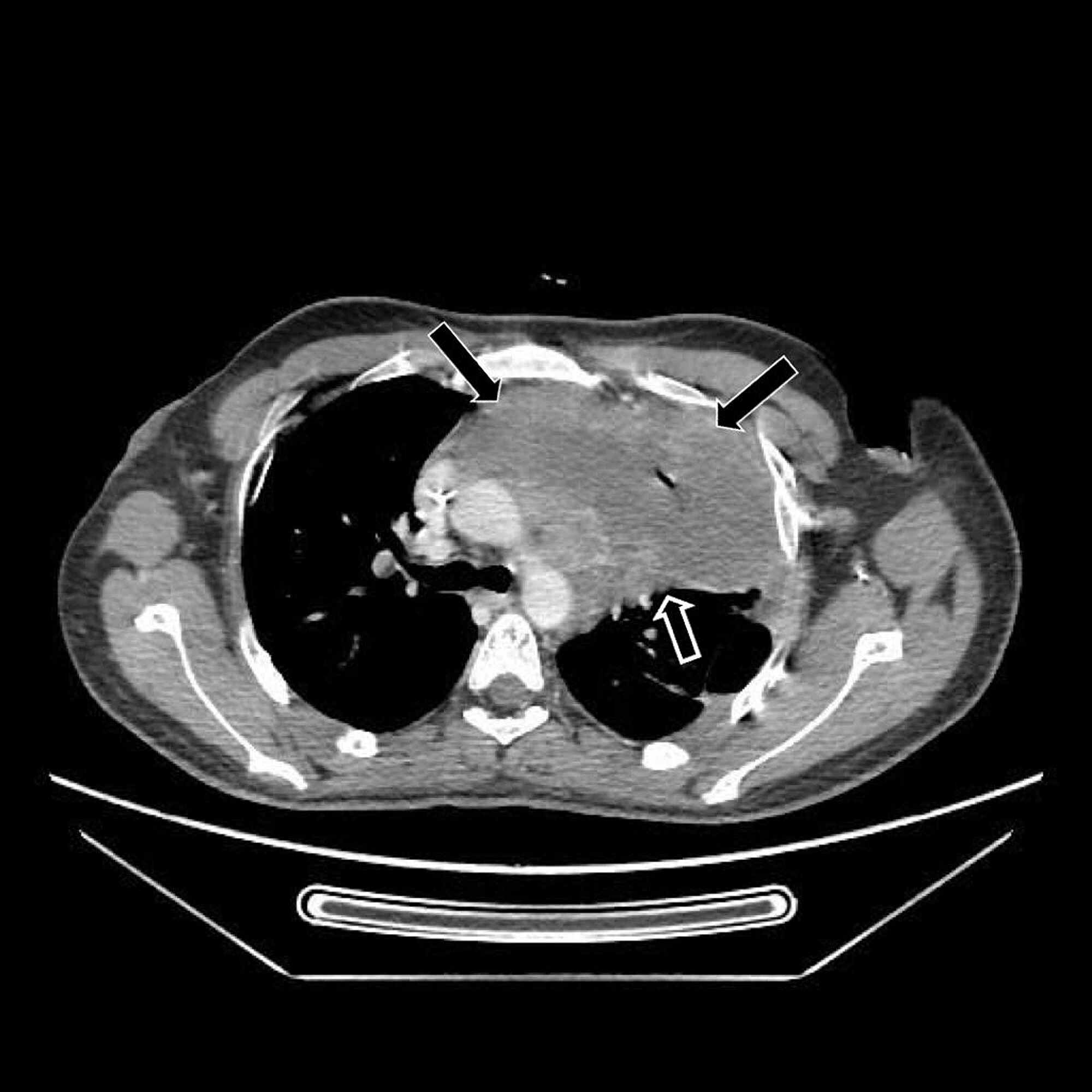 Cureus Mediastinal Germ Cell Tumor With Testicular Microlithiasis 7273