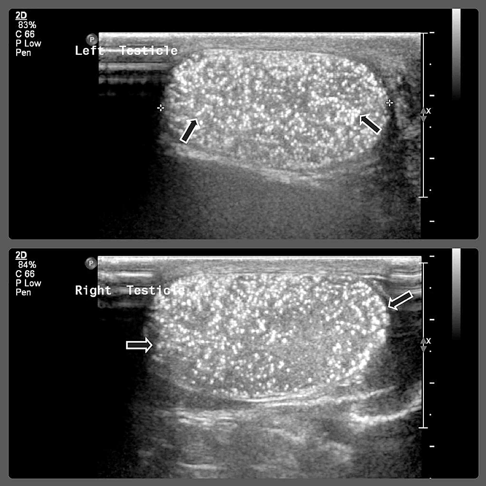 Cureus Mediastinal Germ Cell Tumor with Testicular Microlithiasis