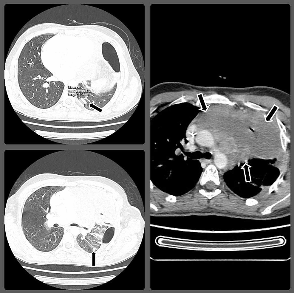 Cureus Mediastinal Germ Cell Tumor With Testicular Microlithiasis