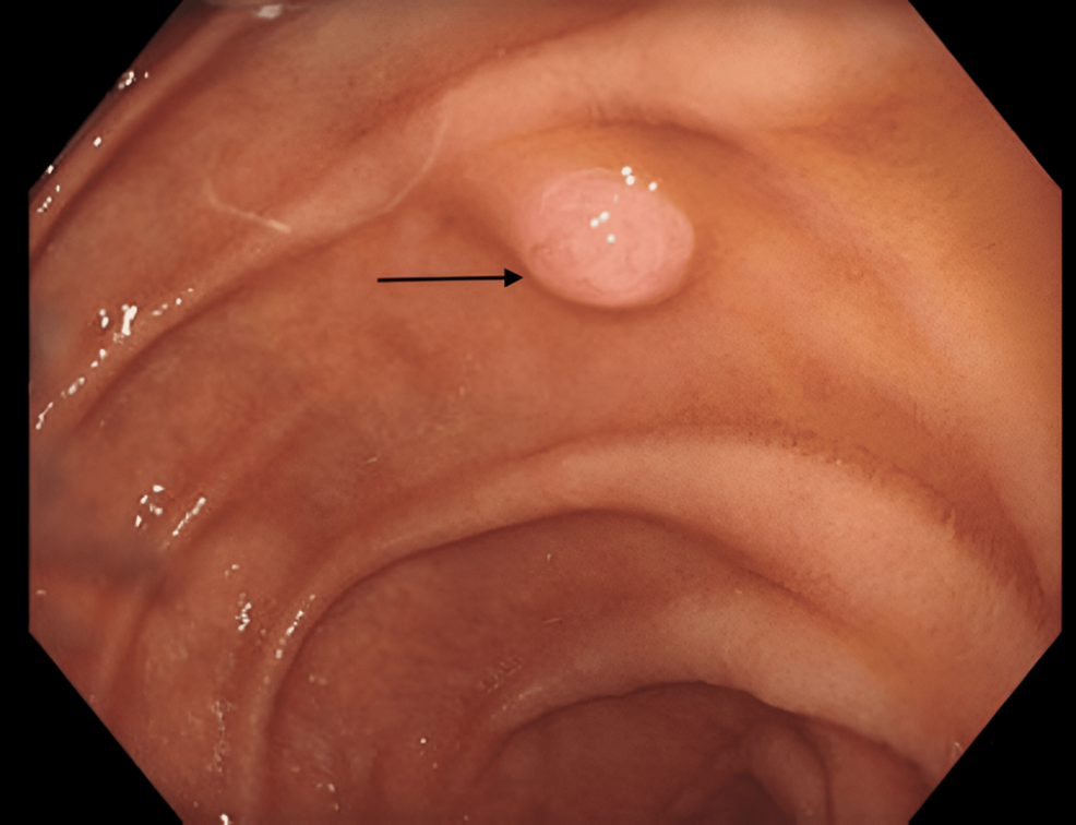 Acute Pancreatitis Following Diagnostic Oesophagogastroduodenoscopy: A Rare Post-procedure Complication