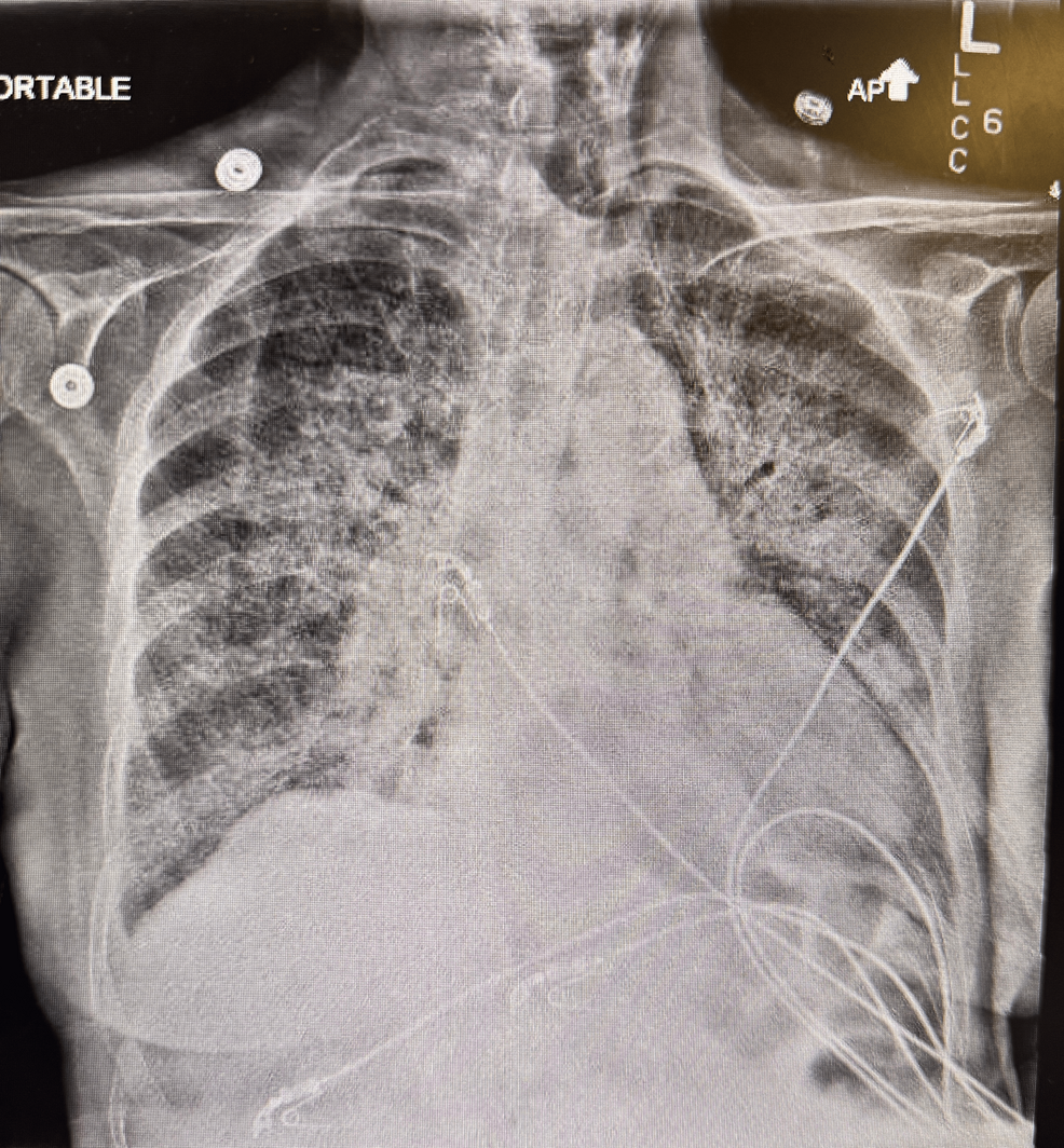 Hemophagocytic Lymphohistiocytosis Associated With Disseminated Histoplasmosis in a Patient With Chronic Pancytopenia: A Rare Case