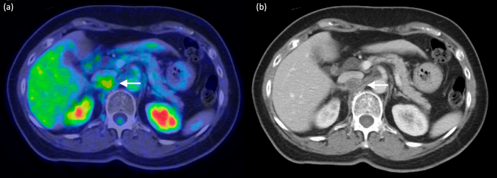 A Diagnostic Pitfall: Retrocaval Nerve Sheath Tumor