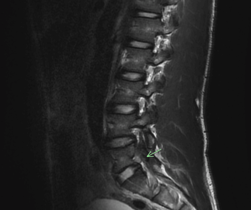 An Unusual Cause of Buttock Pain in a Collegiate Football Player: A Septic Sacroiliac Joint