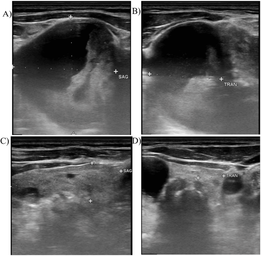 bpc-157 thyroid reddit Papillary Thyroid Carcinoma Presenting as Multinodular Goiter With Possible  Metastasis: A Case Study
