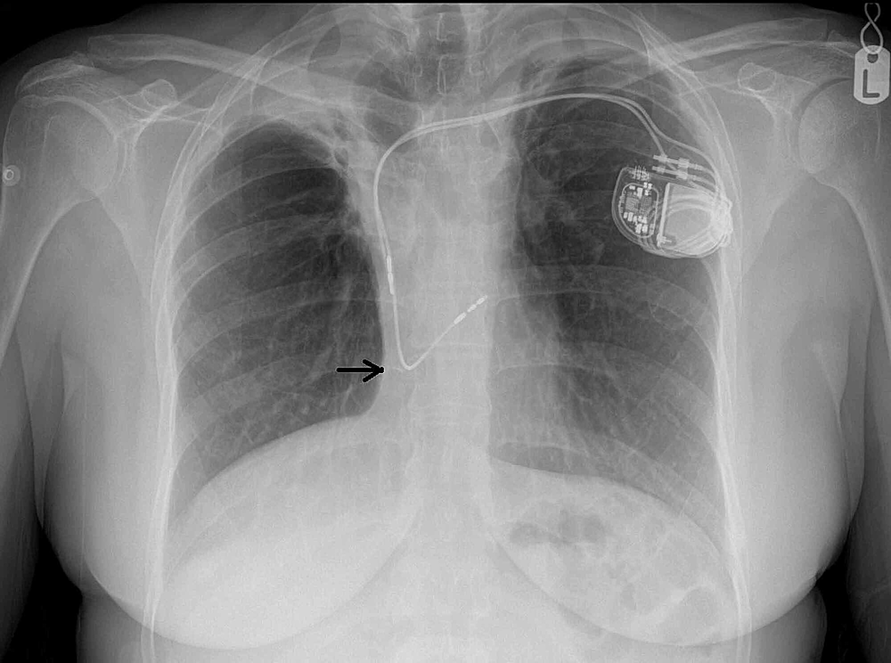 Cureus | Trifascicular Block and Ventricular Standstill: A Late ...