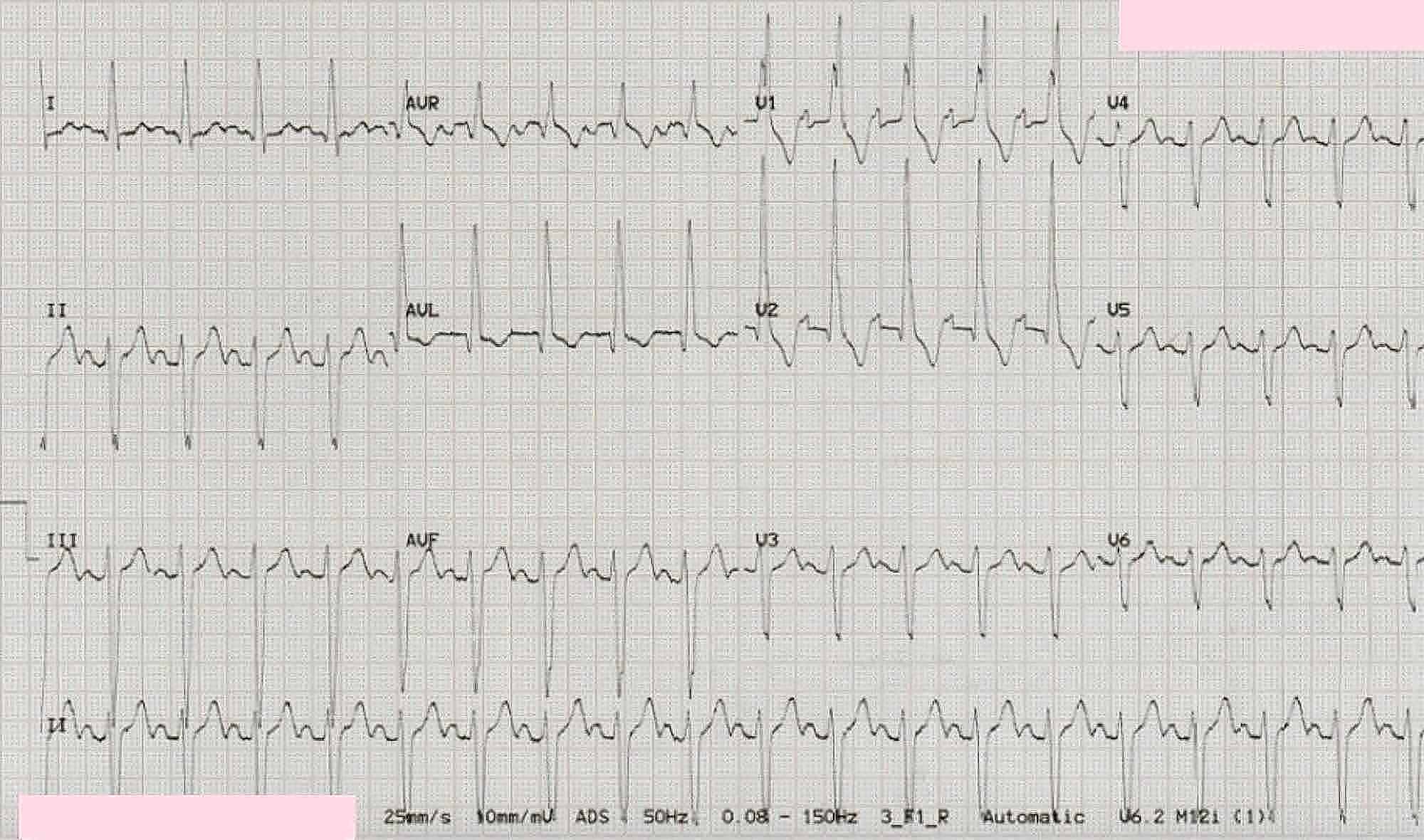 Cureus | Trifascicular Block and Ventricular Standstill: A Late ...