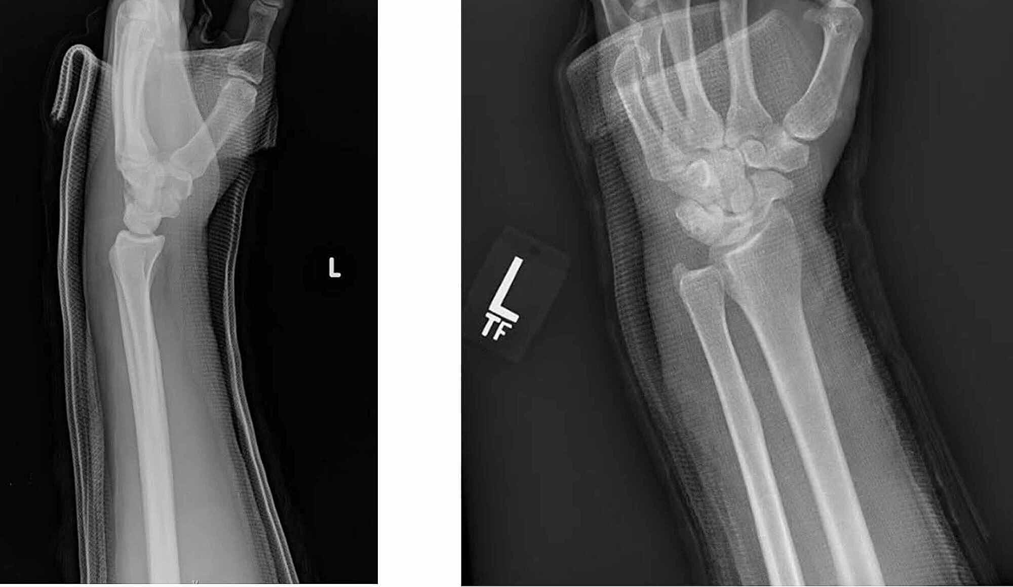 Cureus Isolated Volar Dislocation of the Distal Radioulnar Joint