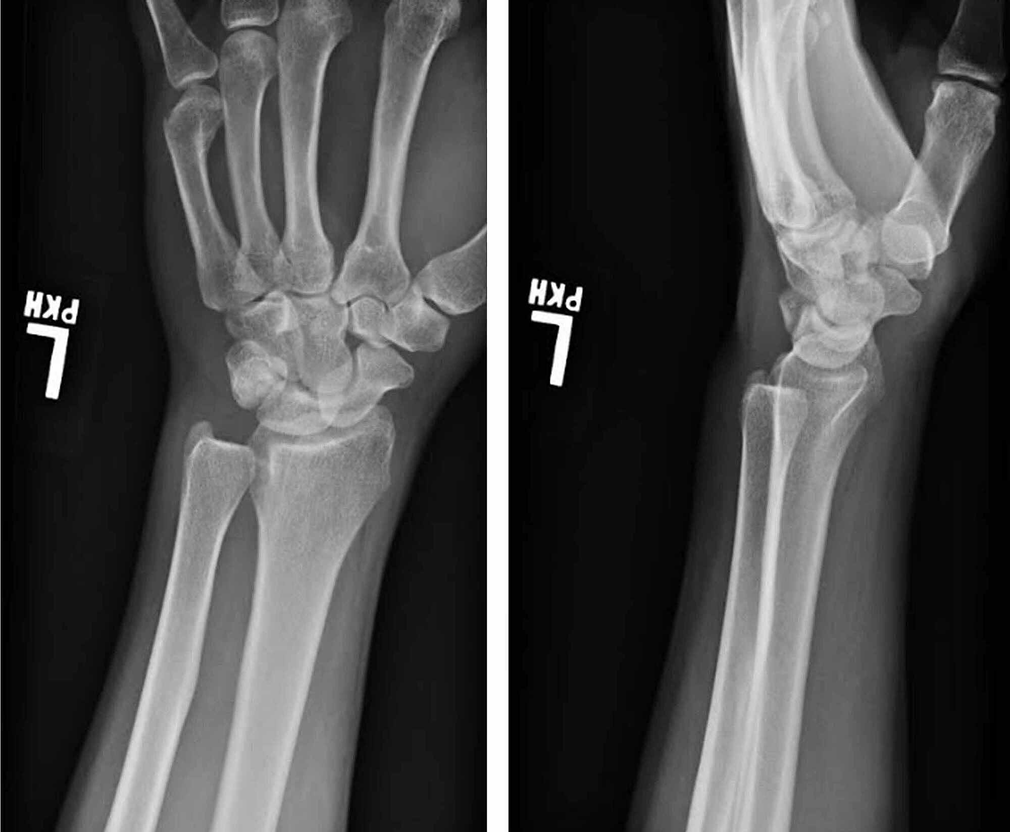 Cureus | Isolated Volar Dislocation of the Distal Radioulnar Joint ...