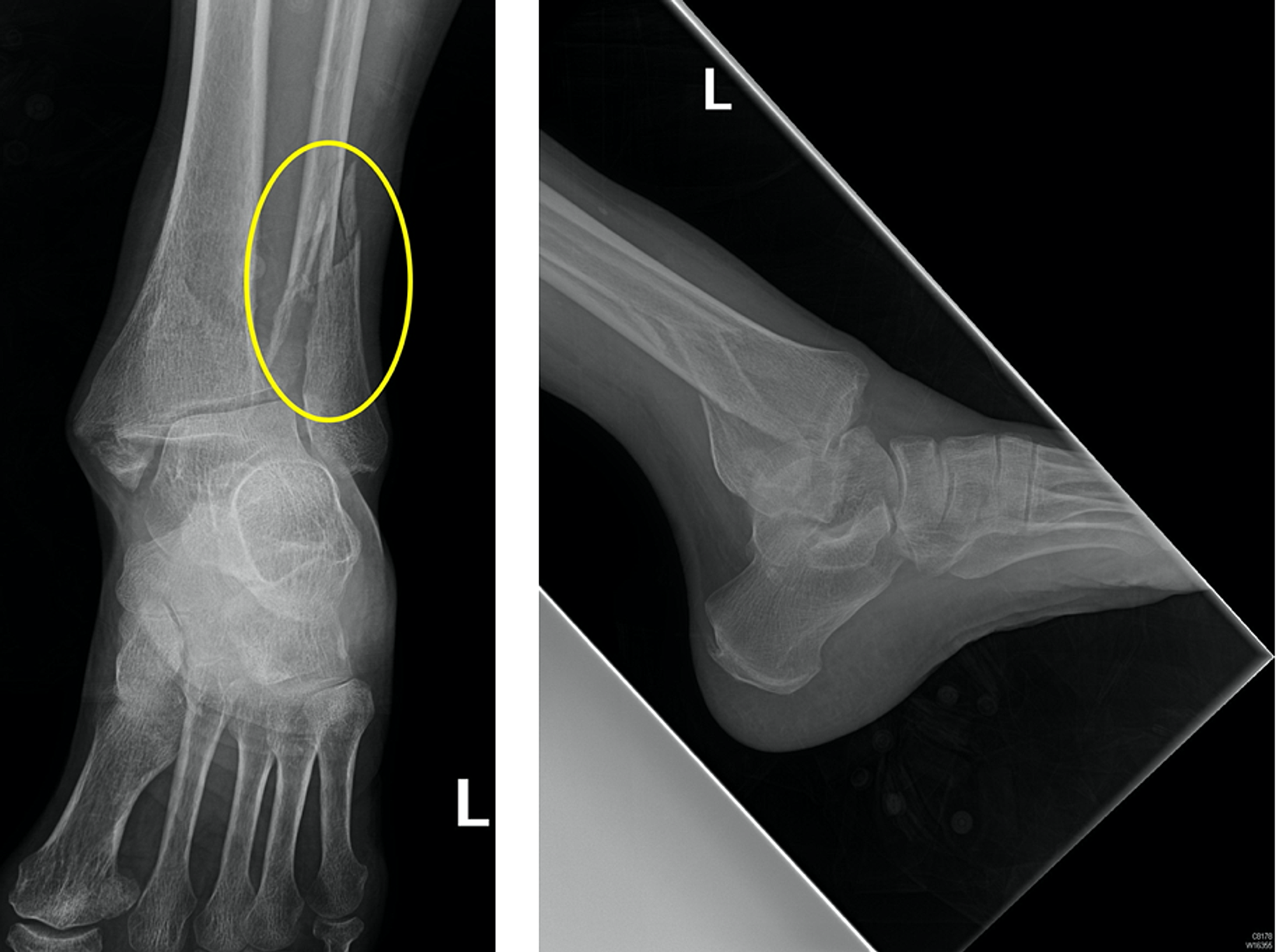 lateral malleolus fracture bruising