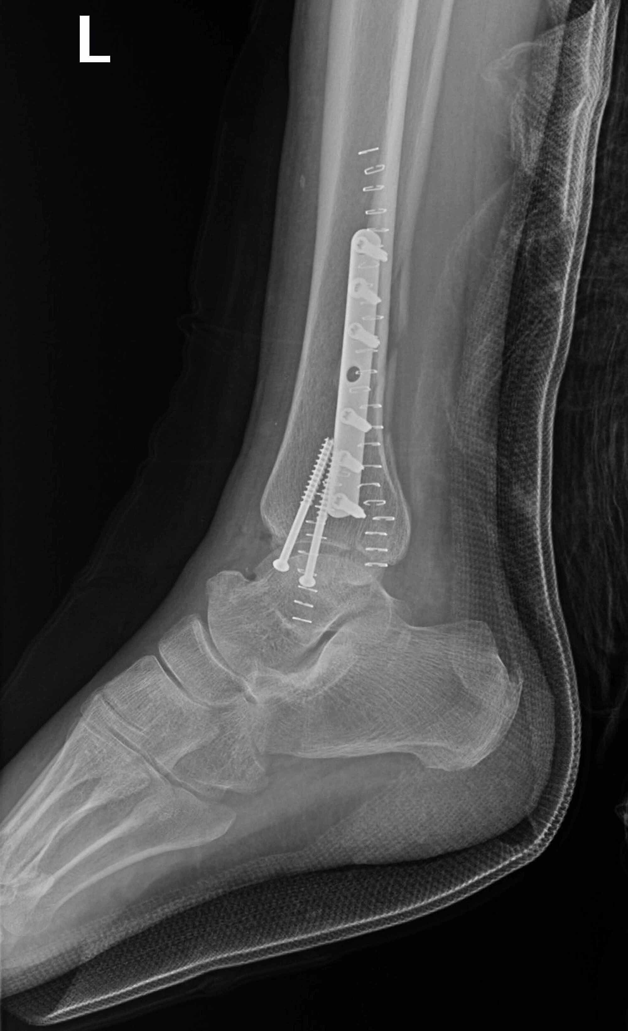 right trimalleolar fracture