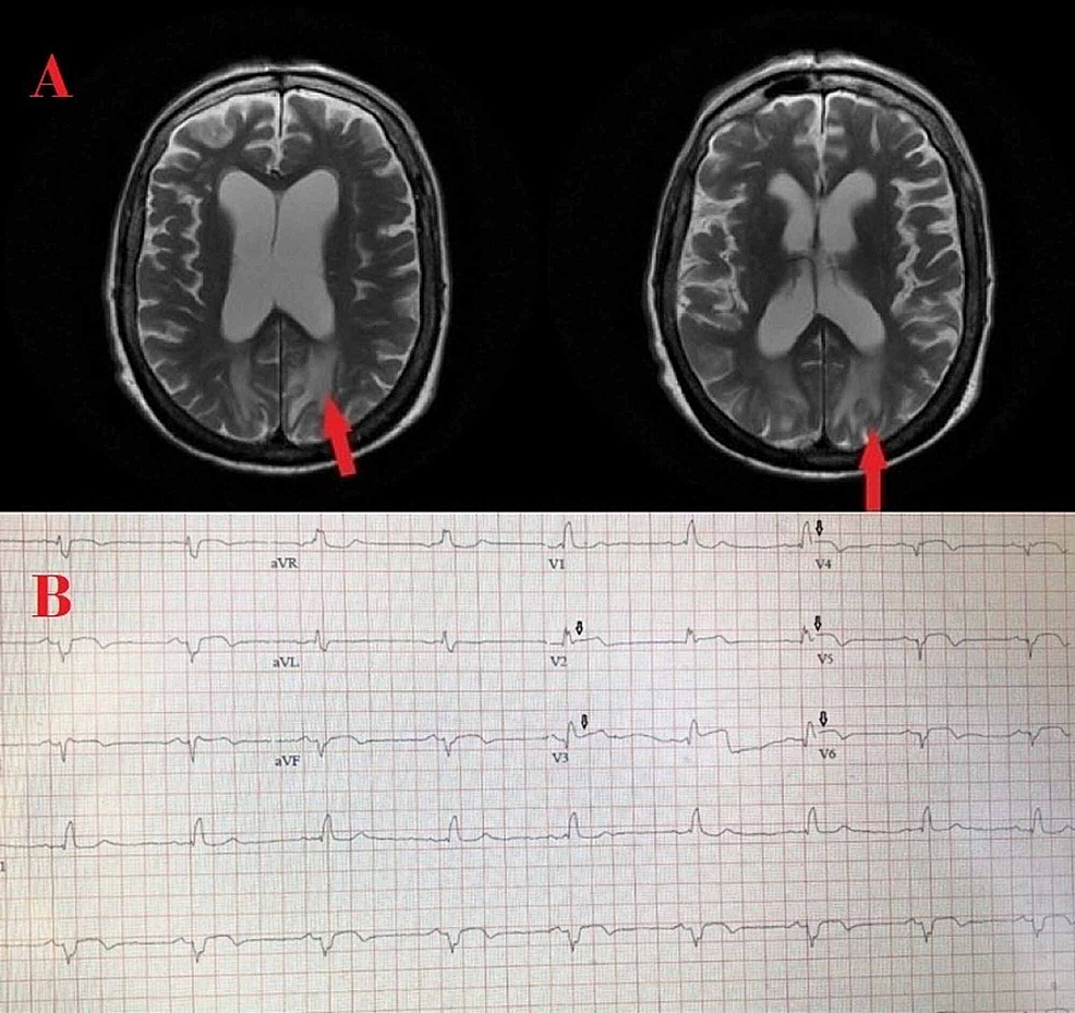 Ayurvedic Treatment of Global LV Hypokinesia