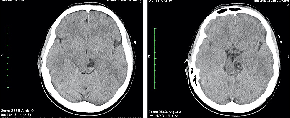 (A-B)-Head-CT-scan-“the-day-after”:-the-multiloculated-cyst-in-the-left-midbrain-showed-fluid-fluid-level,-with-enlargement-of-left-cerebral-peduncle-and-a-slight-mass-effect,-referring-to-enlargement-and-bleeding-of-PVSs.
