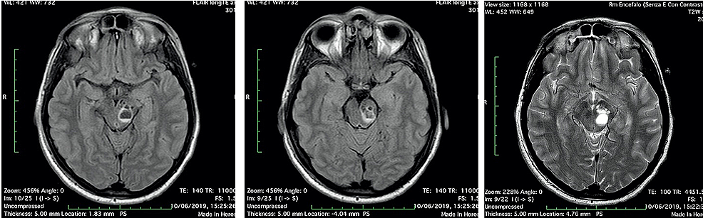 Head-MRI-scan-“the-day-after”:-the-multiloculated-cyst-in-the-left-midbrain-showed-fluid-fluid-level,-with-enlargement-of-left-cerebral-peduncle-and-a-slight-mass-effect,-referring-to-enlargement-and-bleeding-of-PVSs-(3A-3B:-FLAIR-axial-image;-3C:-T2-axial-image).