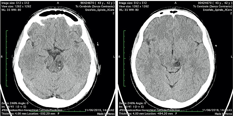 (A-B)-Head-CT-scan-“two-days-after”:-no-significant-changes-of-the-bleeding-PVSs-in-the-left-midbrain.