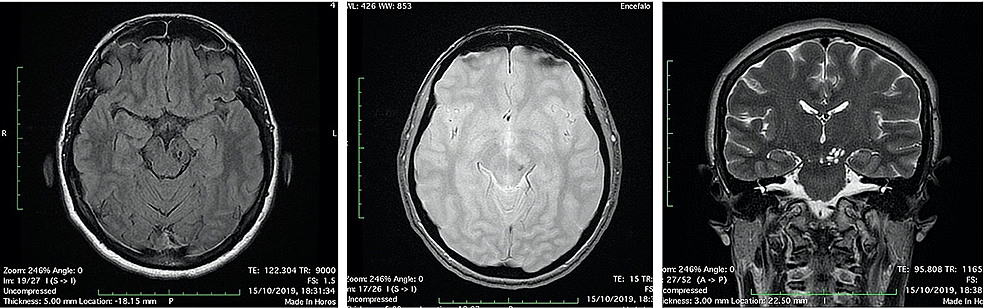 Head-MRI-scan-“after-four-months”:-the-cystic-lesion-was-reduced,-with-punctiform-hemosiderin-sign-(A:-FLAIR-axial-image;-B:-T2-gradient-echo-axial-image;-C:-T2-coronal-image).