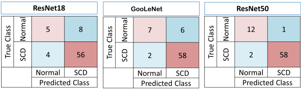 AI in sickle cell detection blood smear