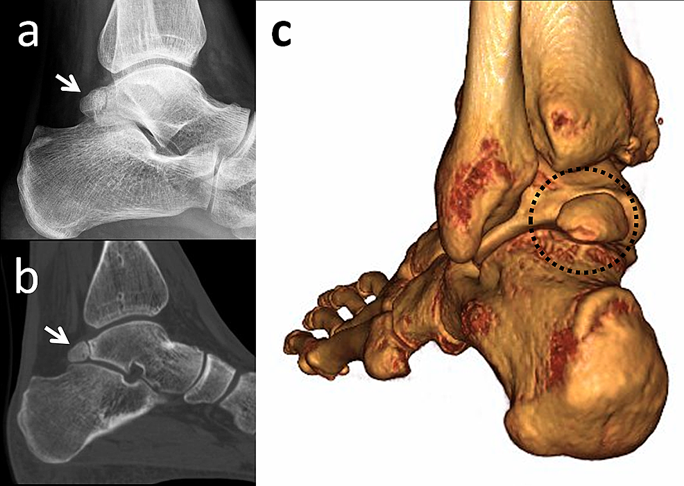 Cureus Accessory Ossicles of the Foot and Ankle Disorders and a