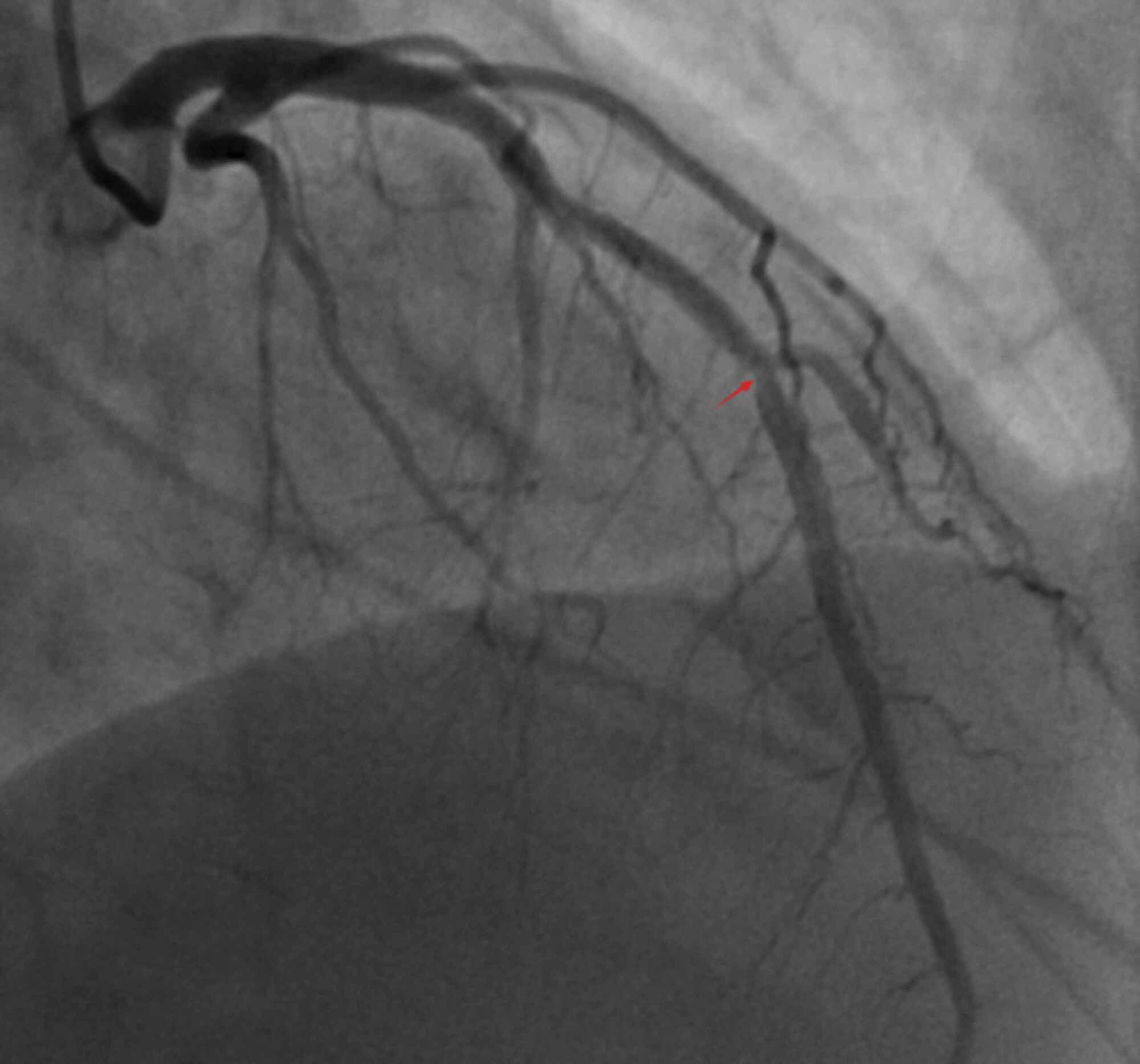 coronary-angiography-left-coronary-angiography-left-anterior-descending