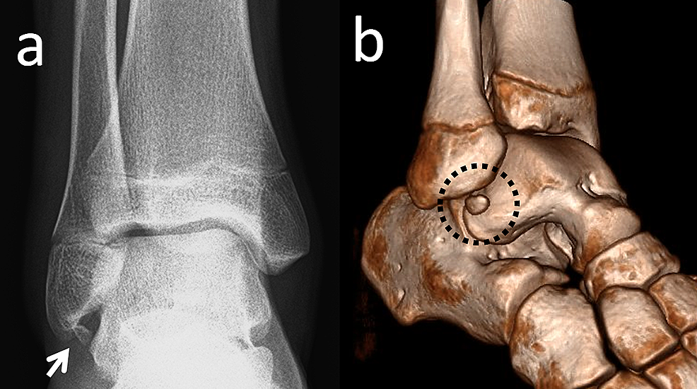 Cureus Accessory Ossicles of the Foot and Ankle Disorders and a