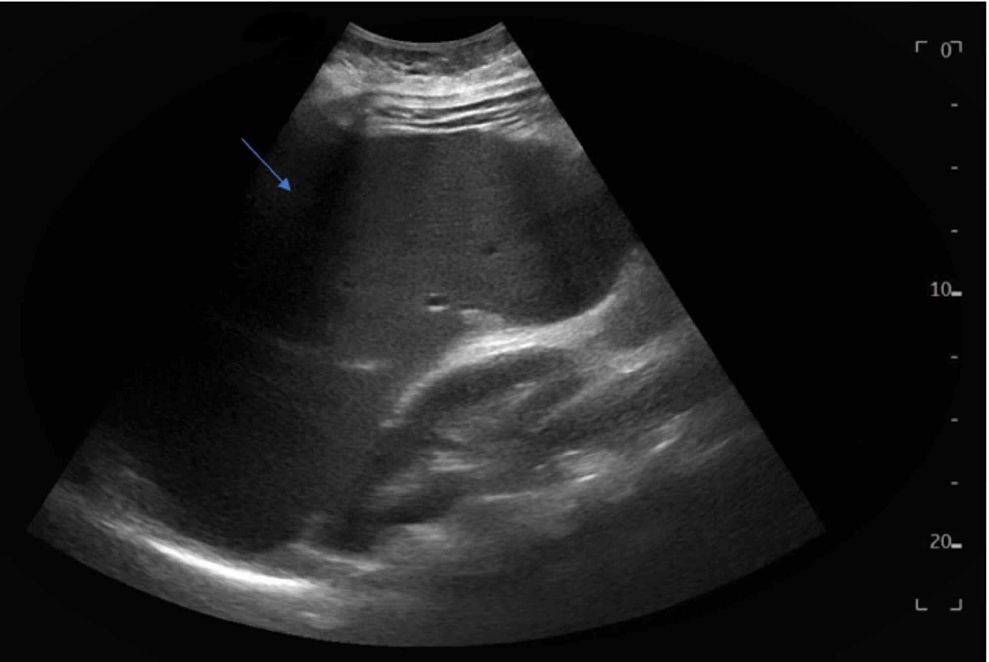 Cureus Liver Cirrhosis Secondary to Autoimmune Hepatitis in a Patient with Alpha1 Antitrypsin